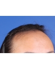 Before Hair Transplant&nbsp;Hairline